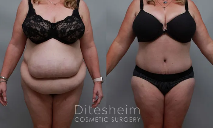 Before and after tummy tuck and body contouring as part of a mommy makeover procedure.