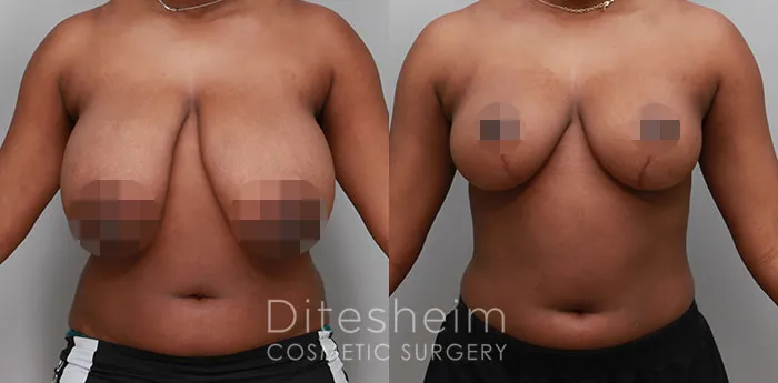 Breast reduction before and after results showing lighter, firmer, and more youthful breast appearance.
