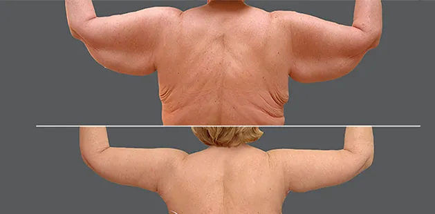 Arm lift before and after at Ditesheim Cosmetic Surgery Charlotte