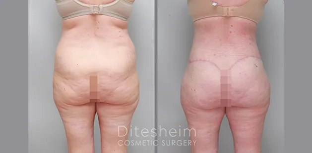 Before and after buttock lift and augmentation showing enhanced contour and smoother lower back transition
