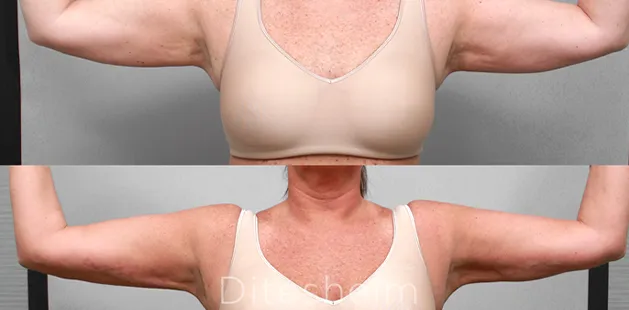 Before and after arm liposuction with Aquashape showing reduced fat and smoother contour