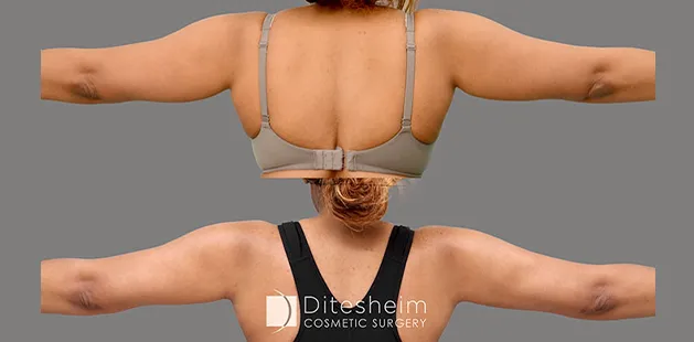 Arm liposuction results at Ditesheim Cosmetic Surgery Charlotte