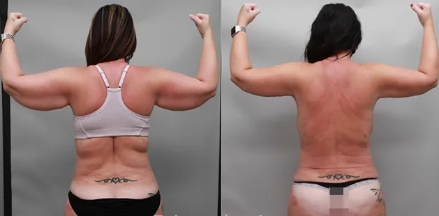 Before and after Renuvion treatment for back and arms showing tighter, smoother skin