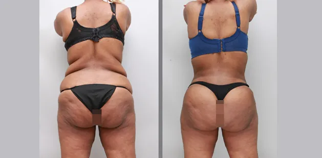 360 tummy tuck before and after weight loss results showing improved lower back and waist contour