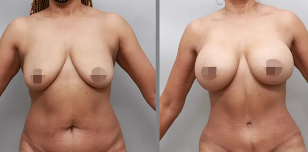 Breast reduction results showing reduction in size and improved breast symmetry.