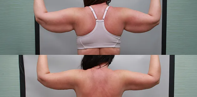 Arm lift with Renuvion showing toned, tightened upper arms post-weight loss at Ditesheim Cosmetic Surgery.