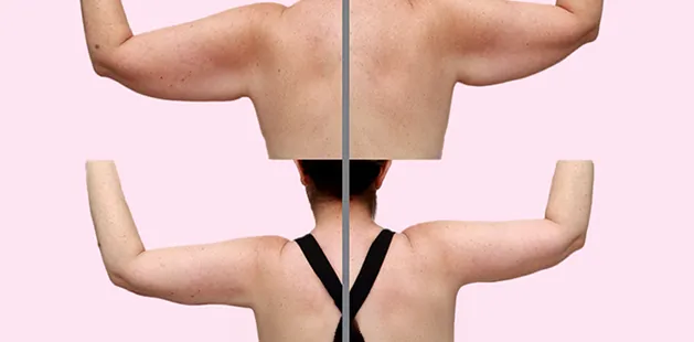 Before and after arm lift results showing reduced upper arm fullness and smoother contour