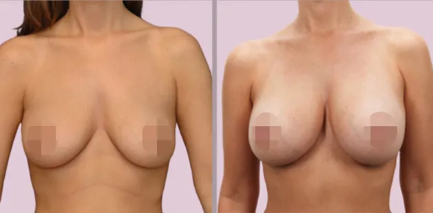 Breast implant results showing restored fullness and youthful contour at Ditesheim Cosmetic Surgery.