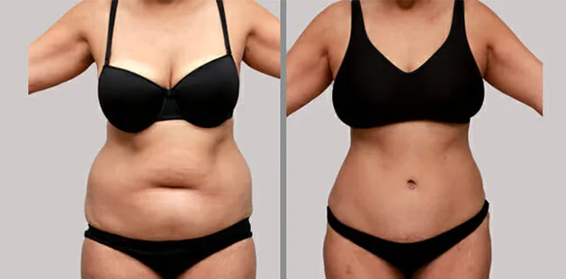 Before and after tummy tuck and body contouring as part of a mommy makeover procedure.