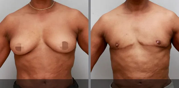 Male chest before and after mild gynecomastia correction showing improved contour and flatter appearance.