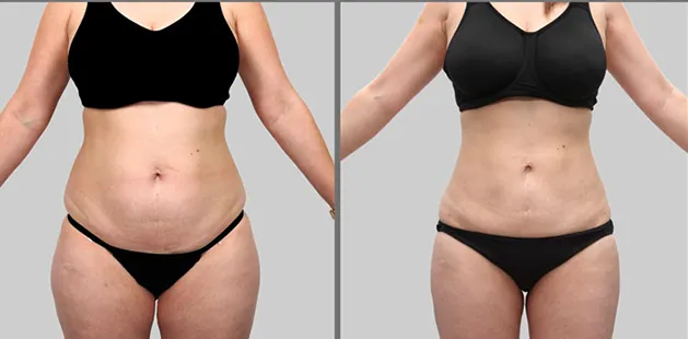 Female abdomen before and after liposuction showcasing improved contour and body definition.