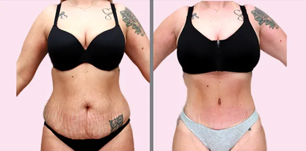 Abdominoplasty before and after at Ditesheim Cosmetic Surgery Charlotte