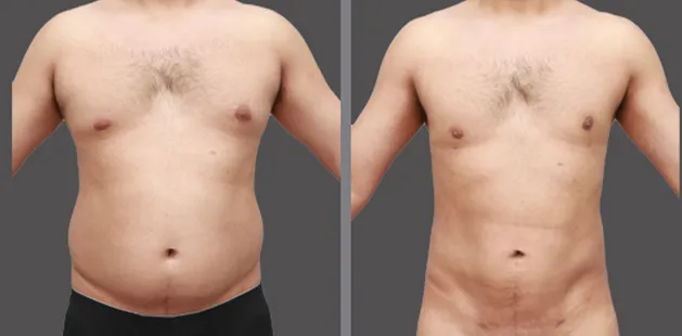Before and after male body sculpting with chest and abdomen enhancement | Charlotte plastic surgery gallery.