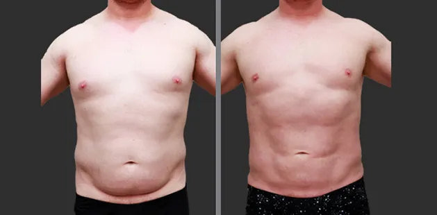 Before and after male body sculpting with chest and abdomen enhancement | Charlotte plastic surgery gallery.