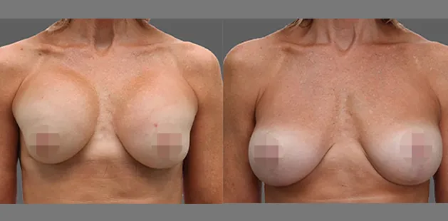 Before and after image showing breast reduction transformation at Ditesheim Cosmetic Surgery Charlotte.