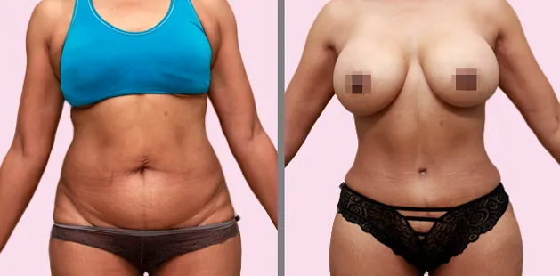 Before and after mommy makeover showing flatter abdomen and lifted breasts at Ditesheim Cosmetic Surgery.