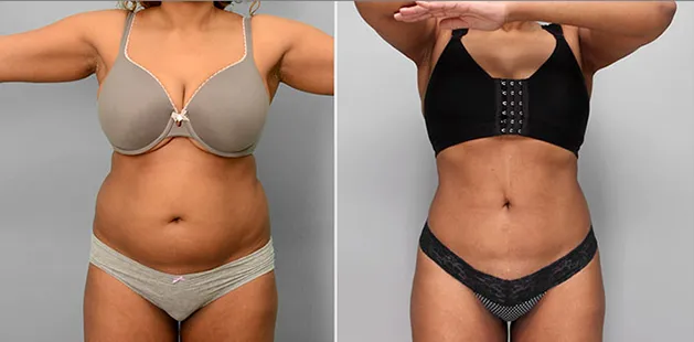 Before and after body contouring and tummy tuck as part of a mommy makeover at Ditesheim Cosmetic Surgery.