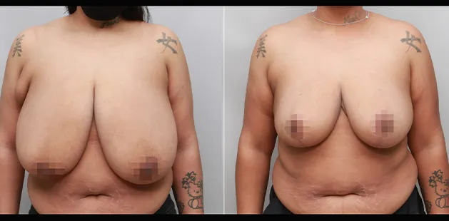 Ditesheim Cosmetic Surgery breast reduction results showing enhanced shape and posture.