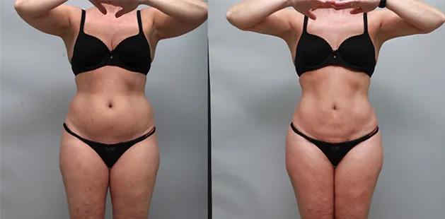Female abdomen before and after liposuction showcasing improved contour and body definition.