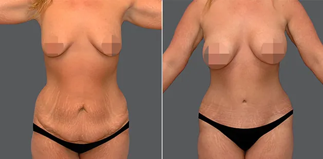 Clinical front view body photo for body contouring evaluation at Ditesheim Cosmetic Surgery in Charlotte NC