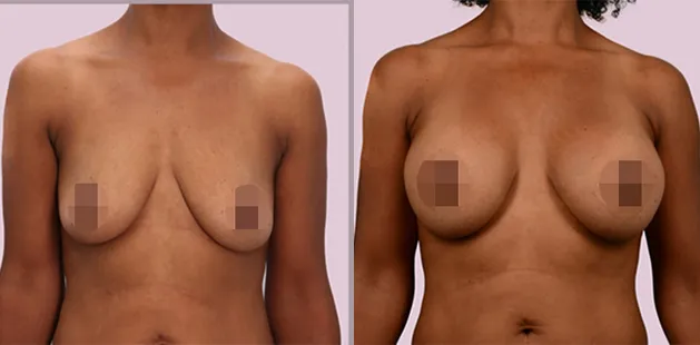 Before and after breast implant procedure showing fuller upper pole and symmetry.