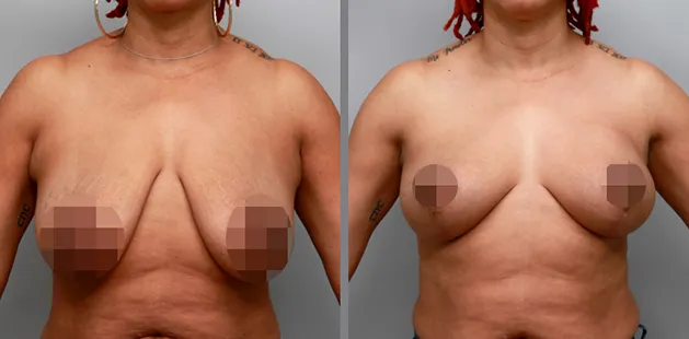 Breast lift procedure results at Ditesheim Cosmetic Surgery showing youthful, balanced enhancement.