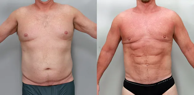 Before and after male liposuction results improving chest and midsection | Charlotte plastic surgery gallery.