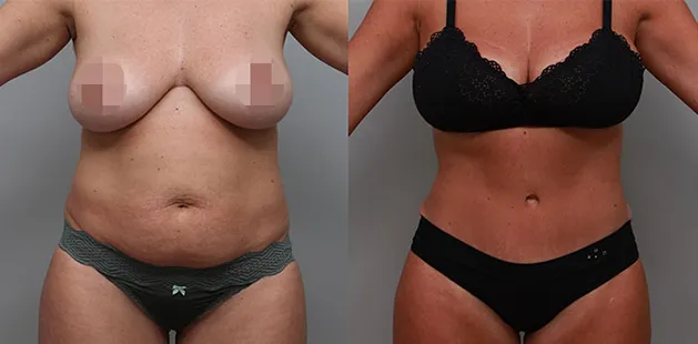 Before and after tummy tuck and body contouring as part of a mommy makeover procedure.