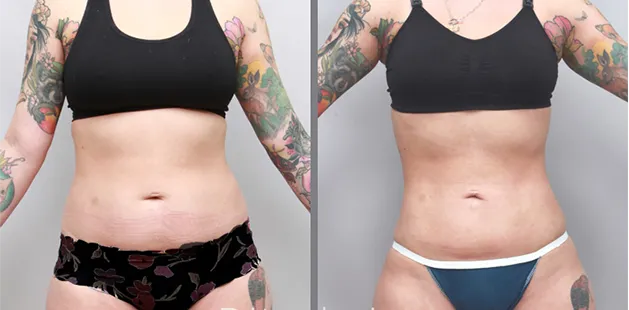 Front view showing noticeable improvement in body shape following liposuction procedure.