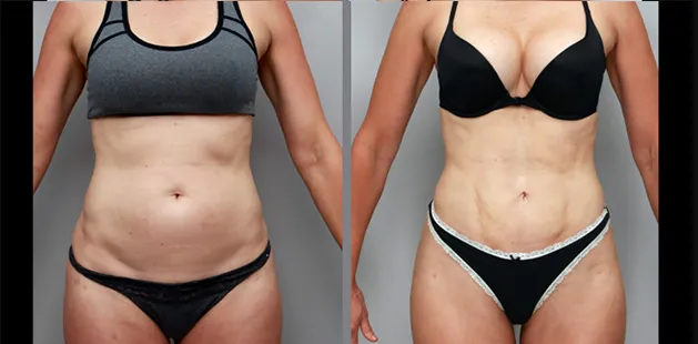 Before and after mommy makeover results showing flatter midsection and enhanced breast contour..