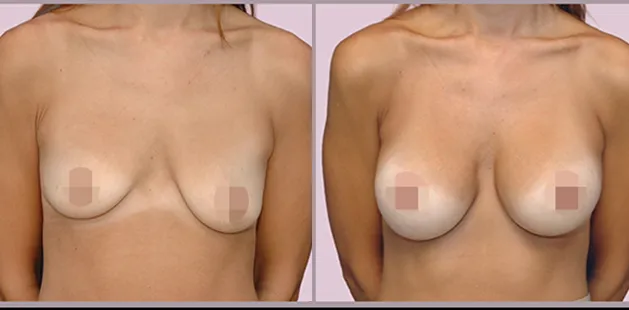 Breast augmentation results showing increased volume and balanced contour.