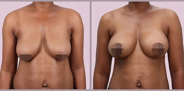 Before and after breast lift results showing enhanced contour and symmetry at Ditesheim Cosmetic Surgery.