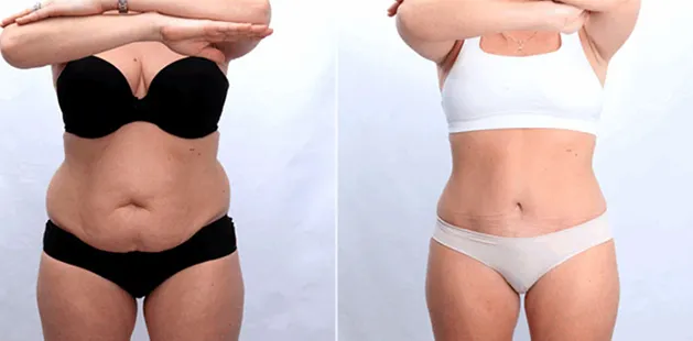 Mommy makeover before and after photo showing tighter, firmer midsection.