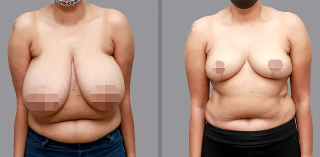 Breast reduction transformation showing lifted, smaller breasts after surgery.