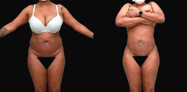 Abdomen contouring before and after liposuction performed at Ditesheim Cosmetic Surgery.