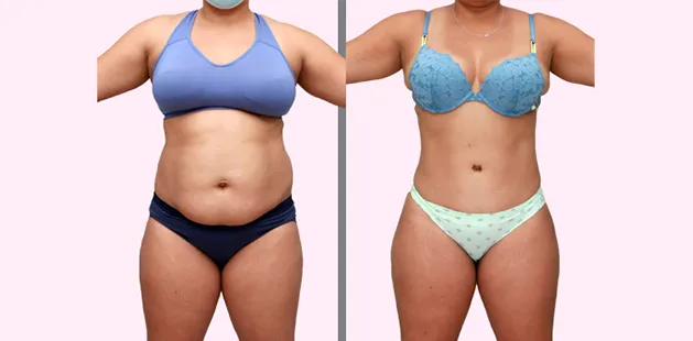 Comprehensive mommy makeover showing improved waistline and lifted bust.