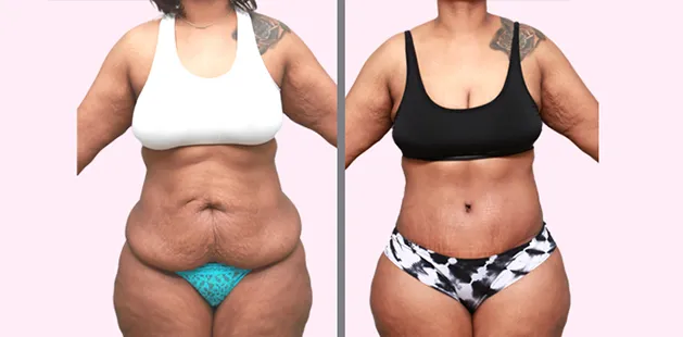 Before and after image showing tummy tuck and body rejuvenation after pregnancy.