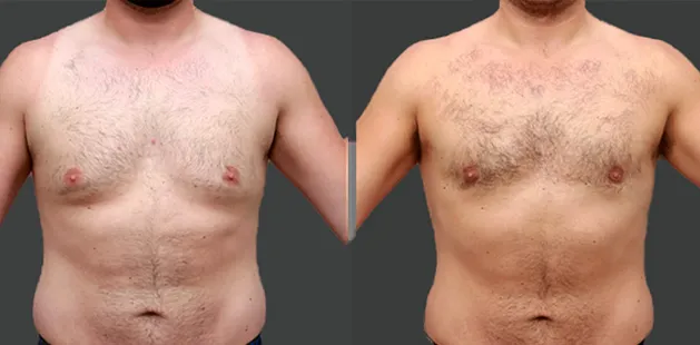 Male gynecomastia surgery results before and after | Ditesheim Cosmetic Surgery.