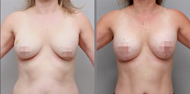 Breast reduction results for woman seeking relief from back pain and improved contour.