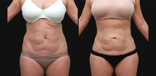 Post-pregnancy body contouring results after mommy makeover at Ditesheim Cosmetic Surgery Charlotte NC.