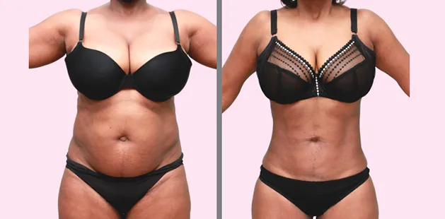 Before and after liposuction results highlighting slimmer waist and toned abdomen.