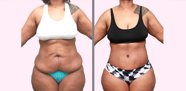 Before and after mommy makeover showing flatter abdomen and lifted breasts at Ditesheim Cosmetic Surgery.