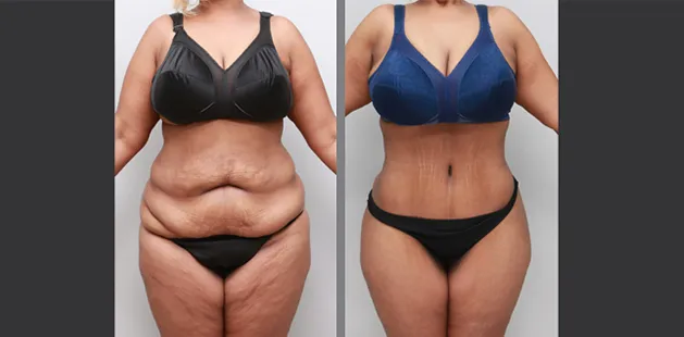 Post-pregnancy body contouring results after mommy makeover at Ditesheim Cosmetic Surgery Charlotte NC.