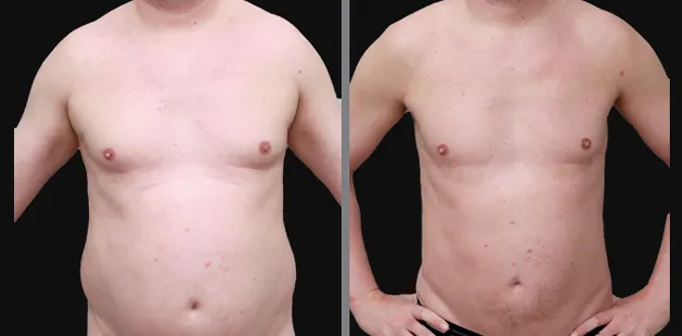 Male plastic surgery before and after showing abdominal contouring and chest definition | Ditesheim Cosmetic Surgery Charlotte.