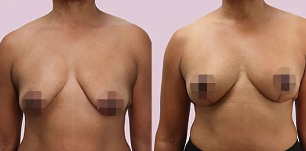 Charlotte NC breast reduction before and after photo showing smaller, lifted breasts.