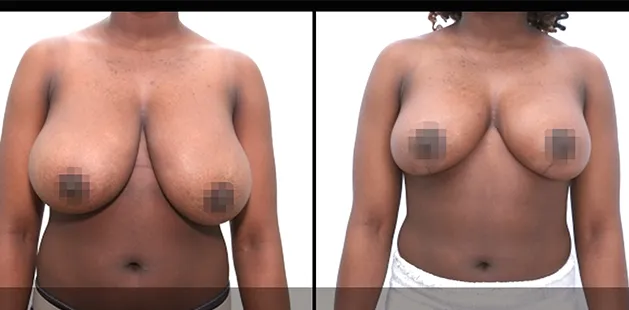 Breast reduction transformation showing lifted, smaller breasts after surgery.