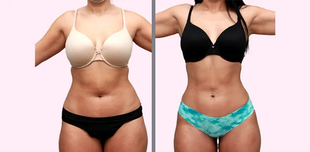 Front view transformation after liposuction treatment for flatter, smoother stomach area.