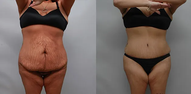 Mommy makeover before and after photo showing tighter, firmer midsection.