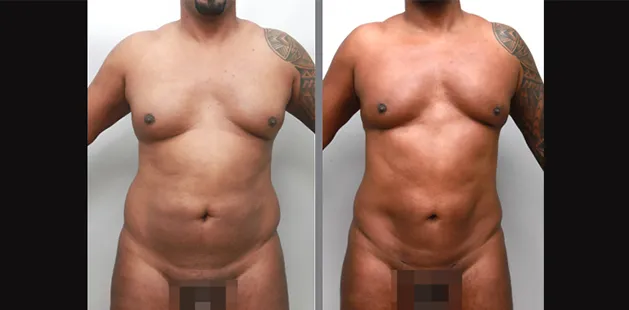 Plastic surgery before and after of male torso contouring | Ditesheim Cosmetic Surgery Charlotte NC.