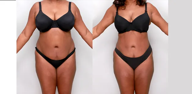 Female abdomen before and after liposuction showcasing improved contour and body definition.